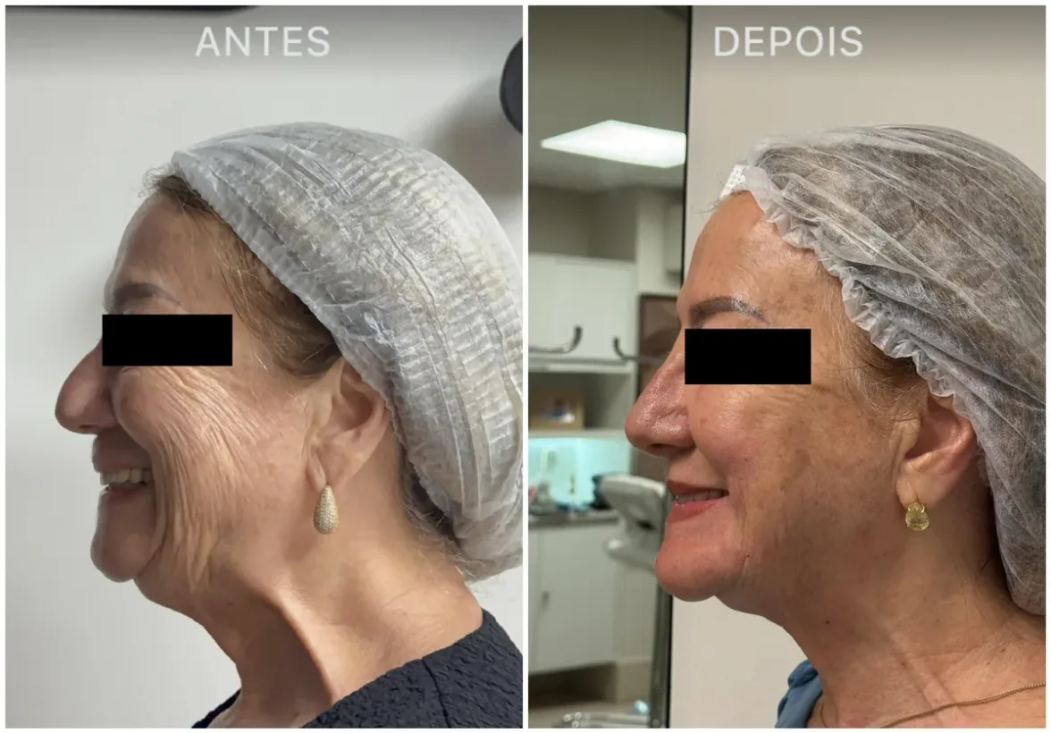 Caso real de tratamento com a Dra. Kelly Melo, antes e depois (6 de 8)