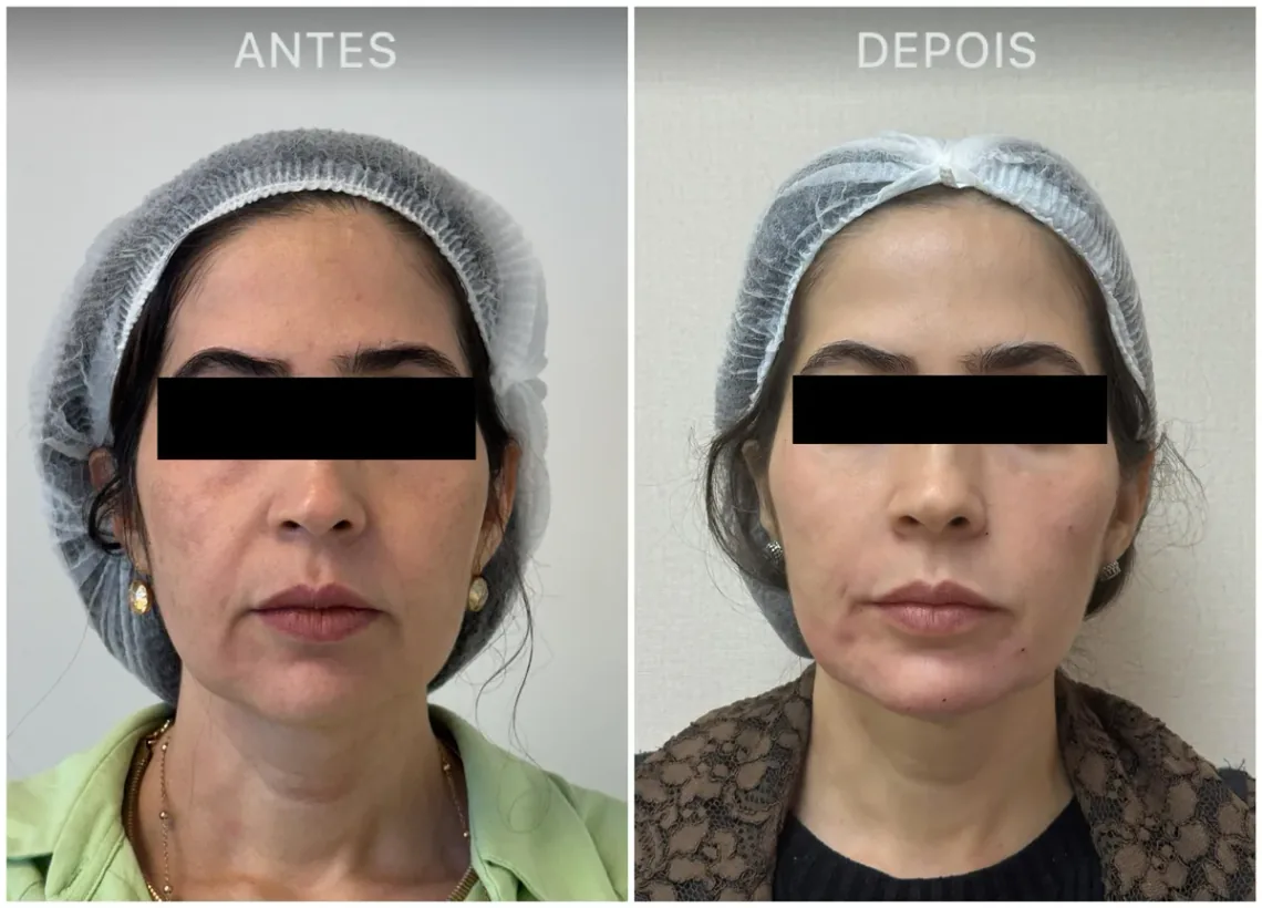 Caso real de tratamento com a Dra. Kelly Melo, antes e depois (7 de 8)