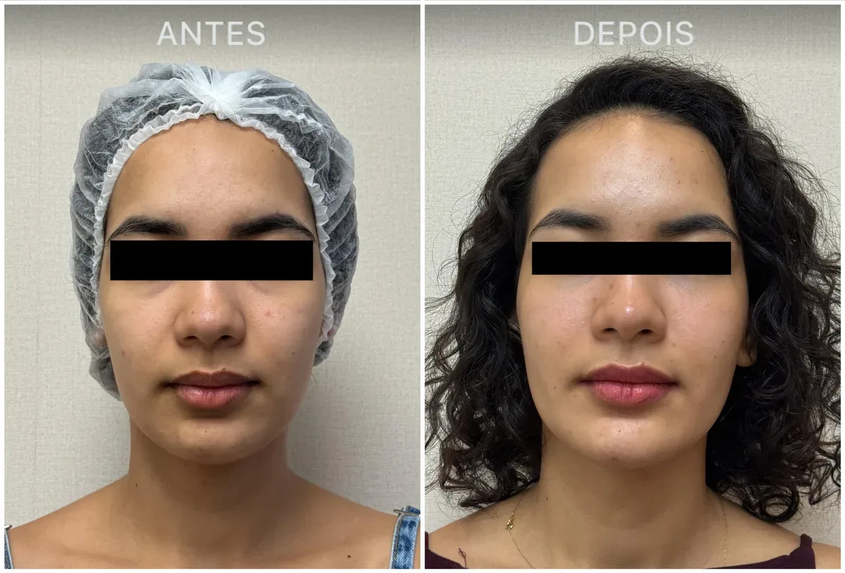 Caso real de tratamento com a Dra. Kelly Melo, antes e depois (8 de 8)